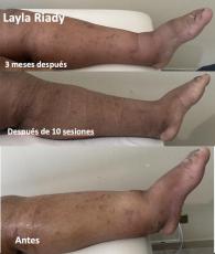 Antes y después de 10 sesiones de terapia descongestiva, y después de 3 meses terminado el tratamiento.